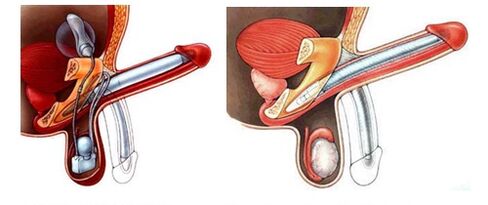 Penile prosthesis with inflatable (left) and plastic (right) prosthesis