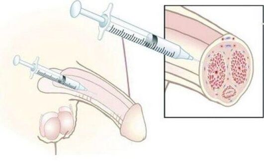 Hyaluronic acid injections of hyaluronic acid injections