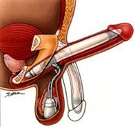 Male penis enlargement prosthesis
